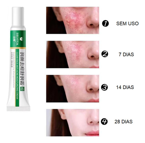03 Creme Tratamento Eficaz Para Acne E Espinhas Oleosa Dia/noite