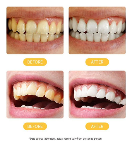 Descamación De Dientes Gingivales, Dientes Refrescantes Para