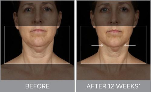 Clarisonic 30% Descuento Smartprofile Uplift 2 En 1 Antiedad