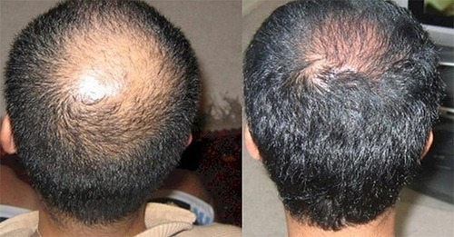 Loción Capilar Contra Calvicie Combo Formula Profesional
