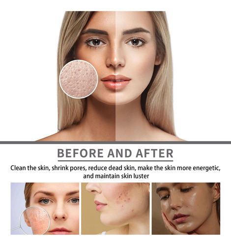Blanqueamiento Facial J Para Cerrar Los Poros Abiertos Y Exf