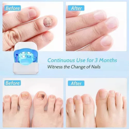 Láser Para Eliminar Hongos En Las Uñas Onicomicosis Uña
