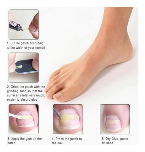 Parches De Corrección De Uñas Pies Encarnadas. Herramienta