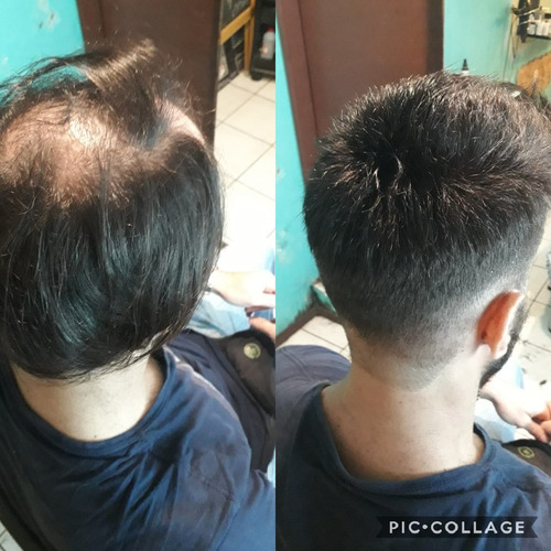 Imagen 2 de 4 de Scalp Protector Thick Walker Para Prótesis Capilar. Usa