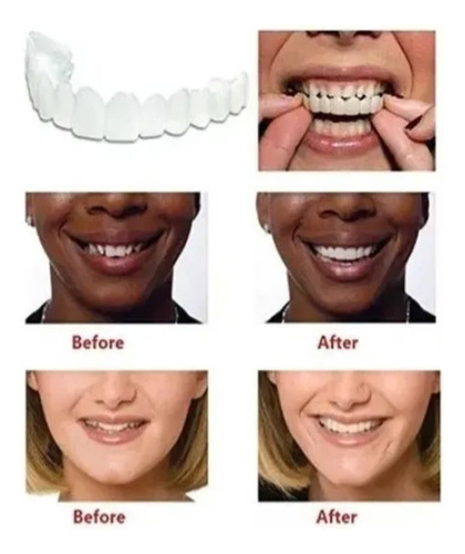 Aparatos De Prótesis Dentales Temporales, 3 Unidades