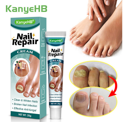 Gel Para El Cuidado De Uñas Y Pies, Blanqueador De Dedos, De