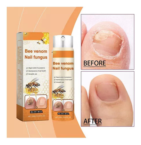 Spray Botella De Calmantes Bee Venom En Las Uñas 2pcs