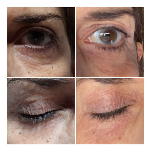 Imagen 4 de 4 de Parpados Caidos. Blefaroplastia No Quirurgica (plasma Laser)