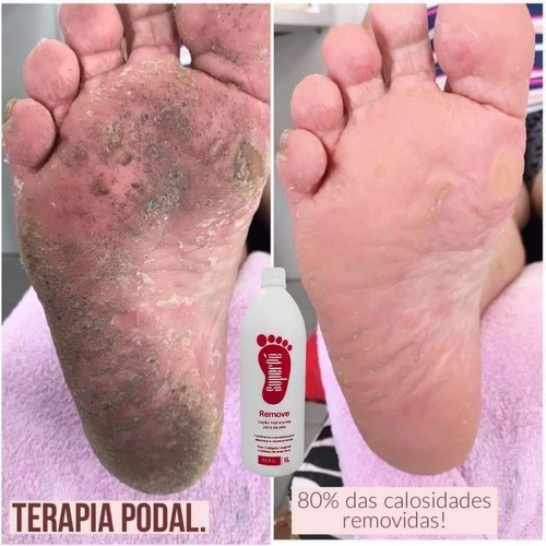 Imagem 2 de 3 de Loção Emoliente De Calosidades Remove Super Pé 1 Litro
