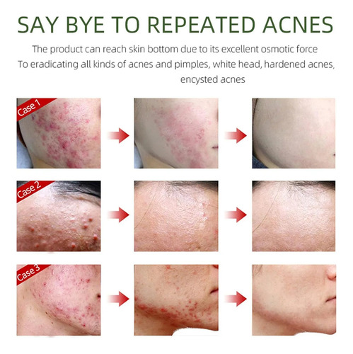 Natural Eliminating Facial//creme Hidratante!