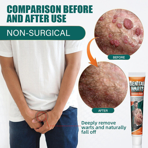 Xinnuo Pomada Para Eliminar Las Verrugas Del Herpes