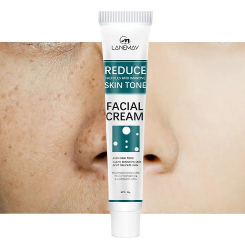 Crema Blanqueadora Para Pecas L, Crema Para Eliminar Manchas