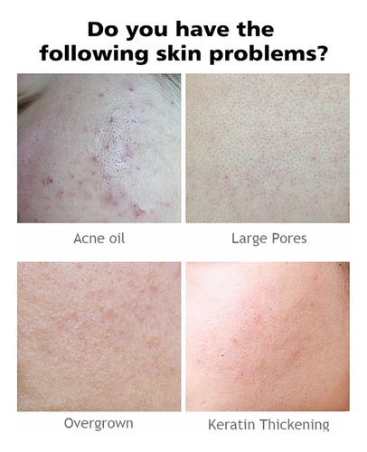 Ácido Salicílico 30ml, Controle De Óleo E Contração De Poros