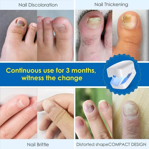 Tratamiento Láser De Hongos En Las Uñas Y Onicomicosis