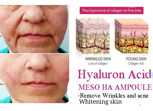 Ácido Hialurónic Colageno  Micromolecular Mesoterapia Facial