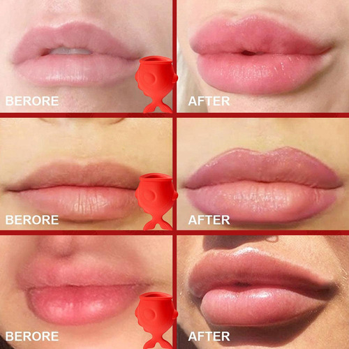 Zl Dispositivo Potenciador De Labios De Pez