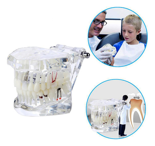 Modelo Dental Typodont Dentalmall 2001c Removible Estándar