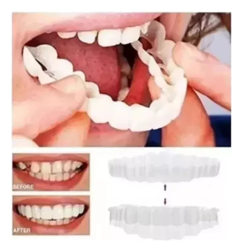 Sorriso Dentes Falsos Folheados W En La Parte Superior/infer
