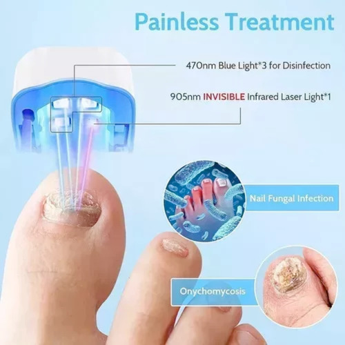 Láser Para Eliminar Hongos En Las Uñas Onicomicosis Uña