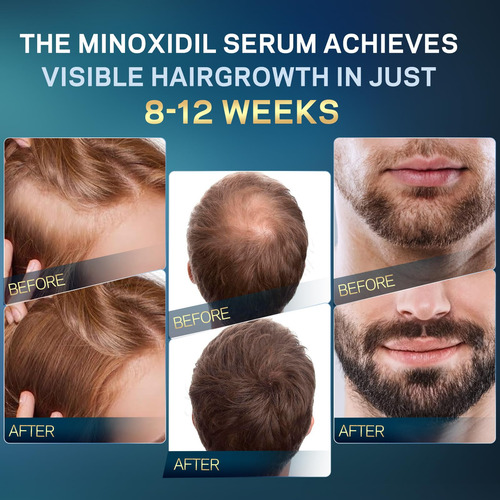 Sérum Para El Crecimiento Del Cabello Amoado 5% Minoxidil Pa
