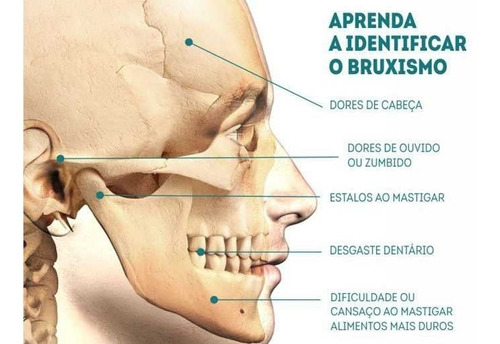 Imagem 2 de 4 de Placa Anti Bruxismo Ranger Os Dentes Protetor Bucal Moldável