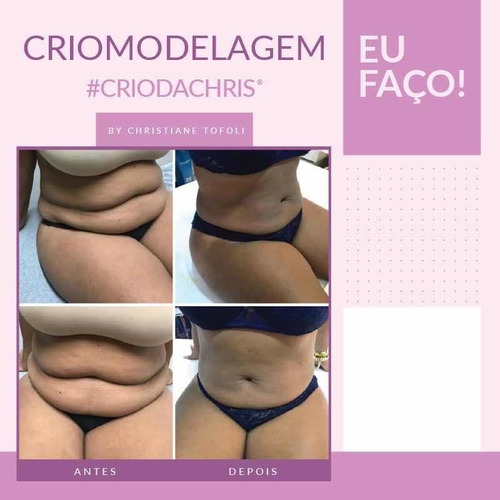 Imagem 5 de 5 de Criomodelagem