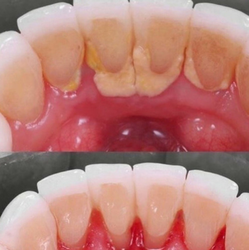 Limpieza Dental Ultrasonido+ Brochita + Flúor Profesional