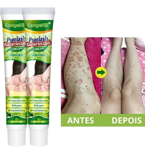  Psoriase Pomada Para Dermatite Atópica Dermatite Alérgica