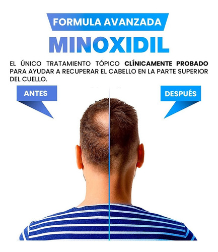 Imagen 2 de 7 de Minoxidil 5% Foam / Espuma 3 Meses Máxima Absorción