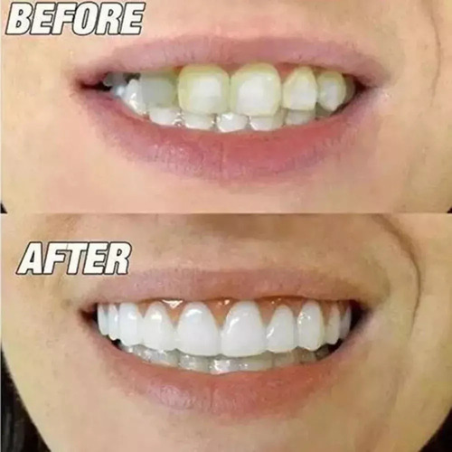 / Nuevo 2juegos De Dentaduras Postizas De Silicona