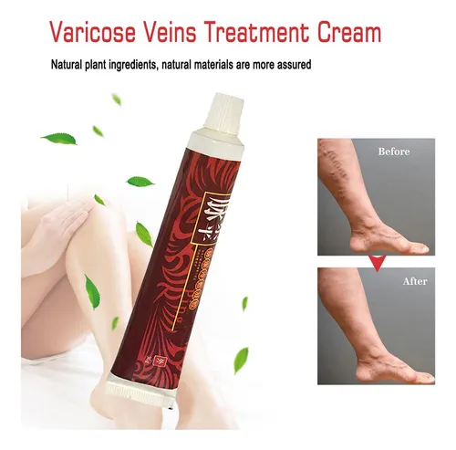 Crema Para Varices, 2 Unidades, 30 G, Tratamiento Para Espin