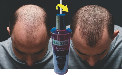 Shampoo + Condicionador De Quina Combate A Queda De Cabelo