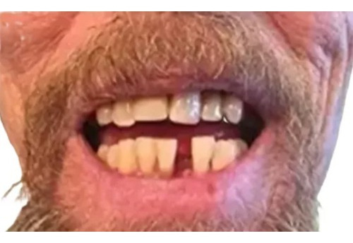 10 Dentes Provisórios A2, De Encaixe, Inferiores+massa Fixar