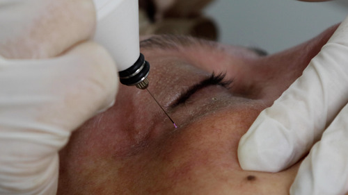 Jato De Plasma Com 5 Ponteiras Plasmaskin Bioset C/ Anvisa
