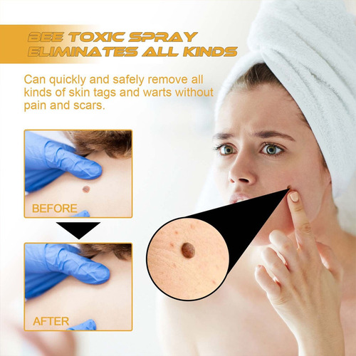 Novo 2* Creme De Remoção De Verrugas Genitais, Pomada Plana