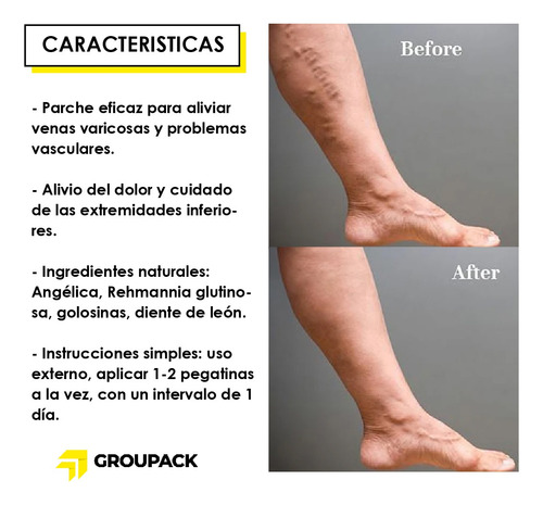 6 Parches Para Eliminar Las Venas Varicosas En Las Piernas