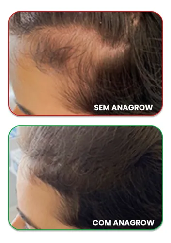 Ferritin12 - Vitamina de combate à queda capilar