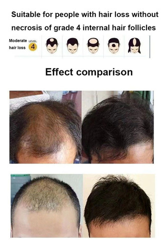 Bone Infravermelho Para Calvície A Laser Duplo Cresce Cabelo