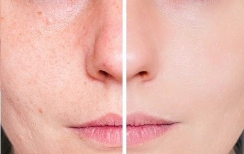Crema Acido Salicilico Topico Rostro Facial Envio Gratis