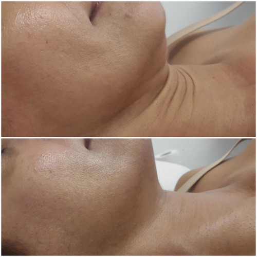 Imagen 3 de 4 de Hifu 7d Ultrasonido Focalizado - Lifting Sin Cirugía