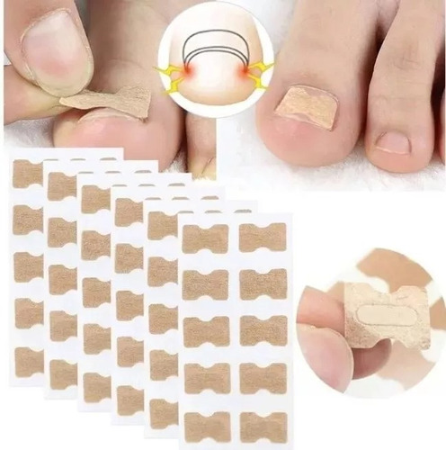 Parche Corrector De Uñas Encarnadas X 10 Unidades