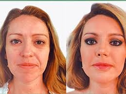 Imagen 1 de 6 de Remodelacion Facial Con Acido Hialuronico.