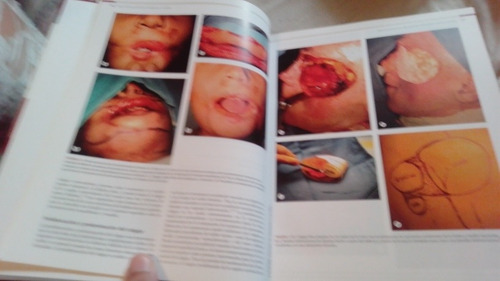 Reconstrucción De Cabeza Y Cuello Elsevier Butler