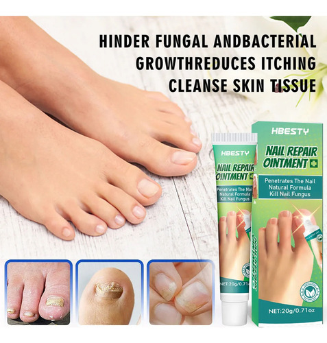 Crema Reparadora De Hongos Para Uñas, Gel Reparador De Uñas,