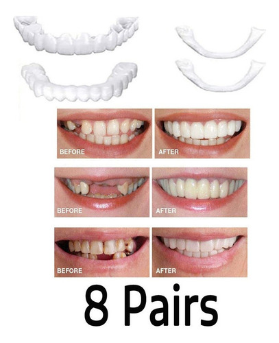 Prótesis Dental De Polietileno 0, Snap On Smile En La Parte