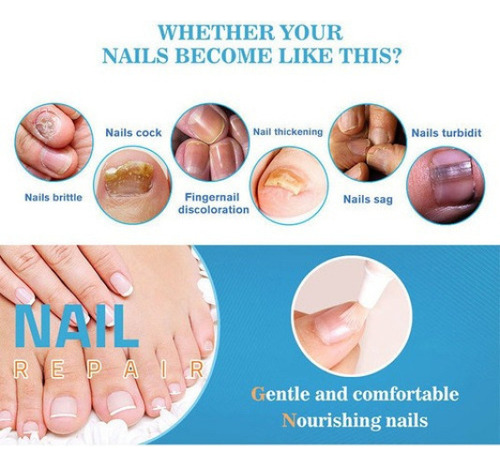 Bolígrafo Con Solución Antimicosis Y Anti Hongos En Las Uñas