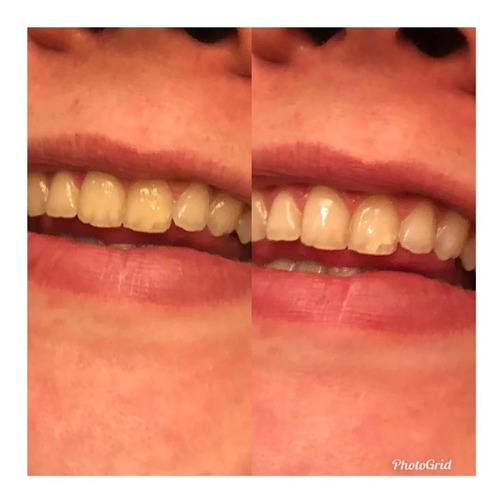 Blanqueamiento Dental Sparkling White Smiles 28 Tiras