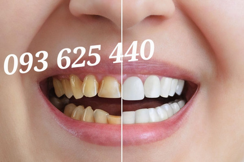 Imagen 3 de 4 de Implantes Dentales Protesis Estética Facial