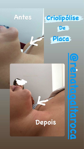 Imagem 2 de 4 de Criolipólise De Placas