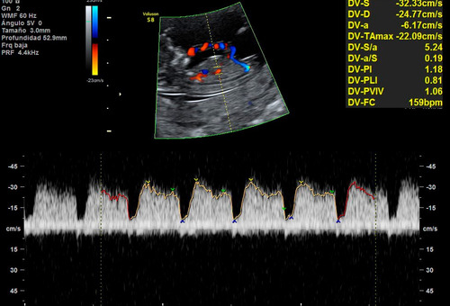 Ecografía Y Ecodoppler Vascular A Domicilio Grales - 5d 4d